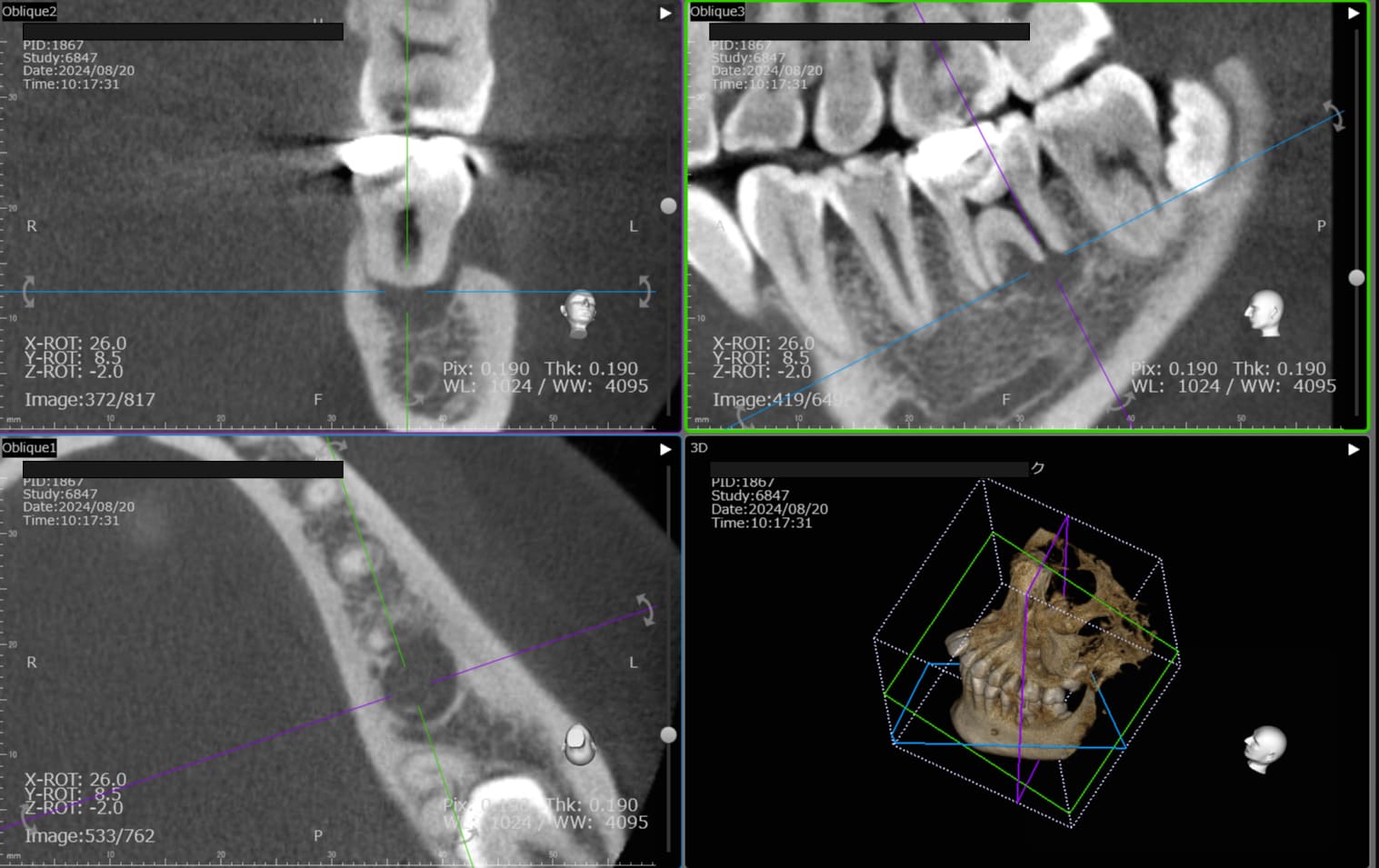 歯科用CTによる三次元診断