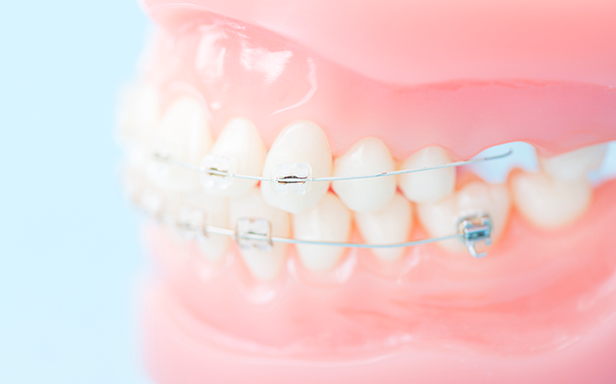 前歯だけの部分的な矯正とは？