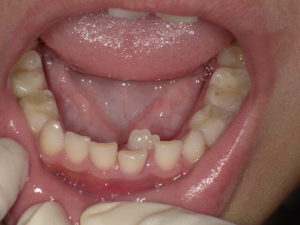 永久歯が内側から生えてきた場合、矯正は必要？小児の歯並びに関して解説