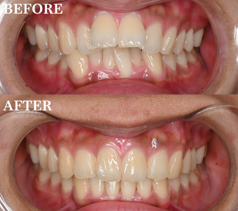 マウスピースで前歯を治したい