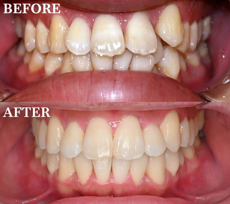 全体的に歯並び気になる