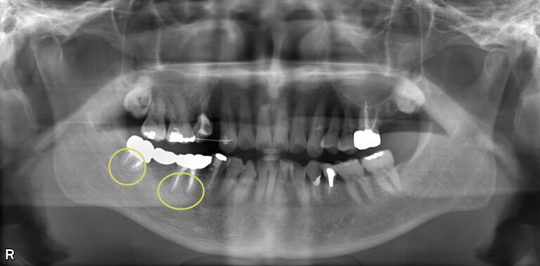 根管感染と虫歯を併発した複合症例の治療