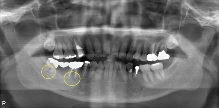 根管感染と虫歯を併発した複合症例の治療