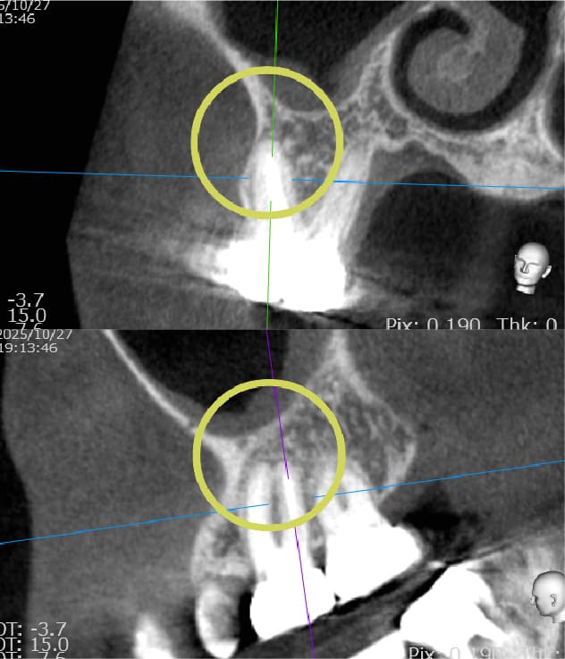 上顎洞炎を伴う根尖病変に対するマイクロスコープ下の根管治療