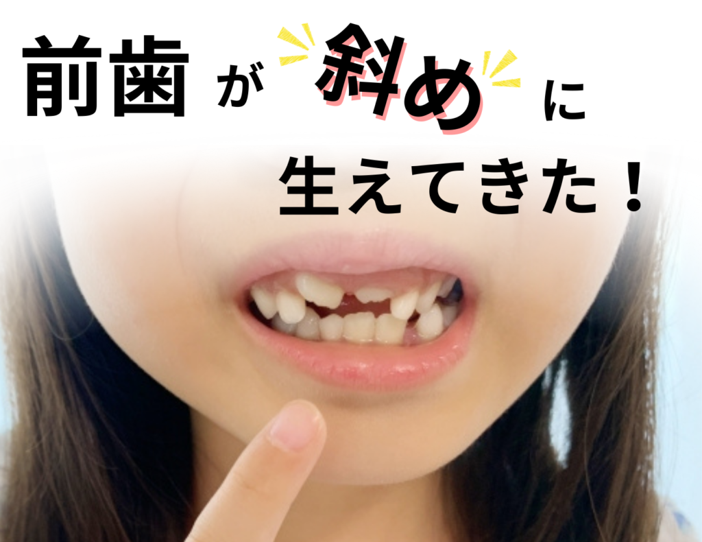 前歯が斜めに生えてきた・・これって大丈夫？